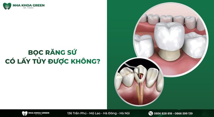 Bọc răng sứ có lấy tủy không?
