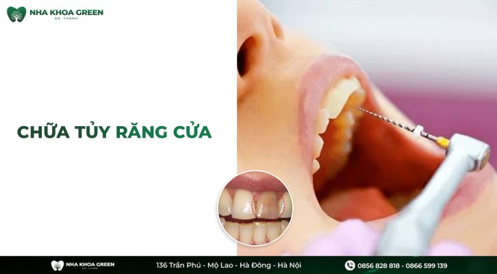 Những điều cần biết khi chữa tủy răng cửa