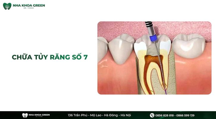 Viêm tủy răng số 7 là gì? Quy trình chữa tủy răng số 7