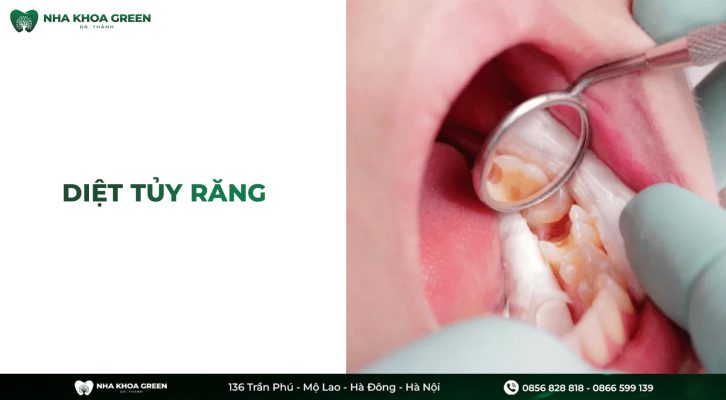 Vì sao cần diệt tủy răng khi răng bị viêm tủy?