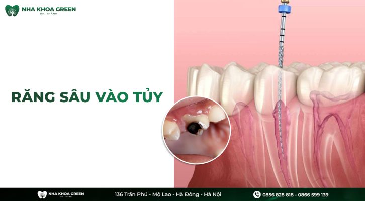 Răng sâu vào tủy: Dấu hiệu và phương pháp điều trị hiệu quả