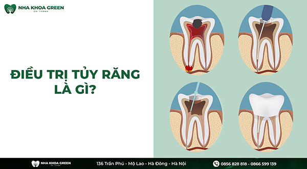Tại sao nên điều trị tủy răng sớm? Địa chỉ điều trị tủy răng uy tín