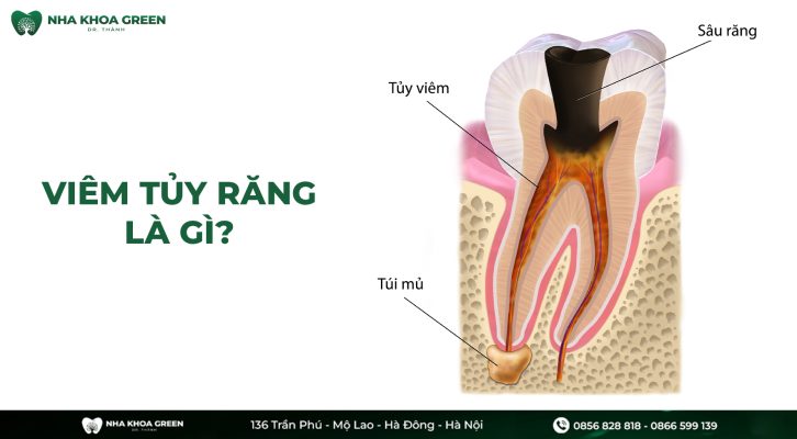Viêm tủy răng là gì? Có nguy hiểm hay không?