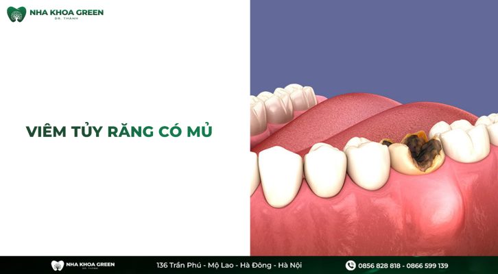 Viêm tủy răng có mủ: Nguyên nhân và cách điều trị hiệu quả