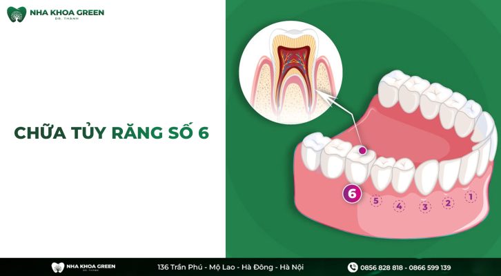 Những điều cần biết khi chữa tủy răng số 6