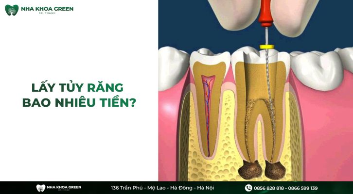 Lấy tủy răng bao nhiêu tiền? Răng lấy tủy có nên bọc lại không?