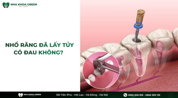 Nhổ răng đã lấy tủy có đau không?