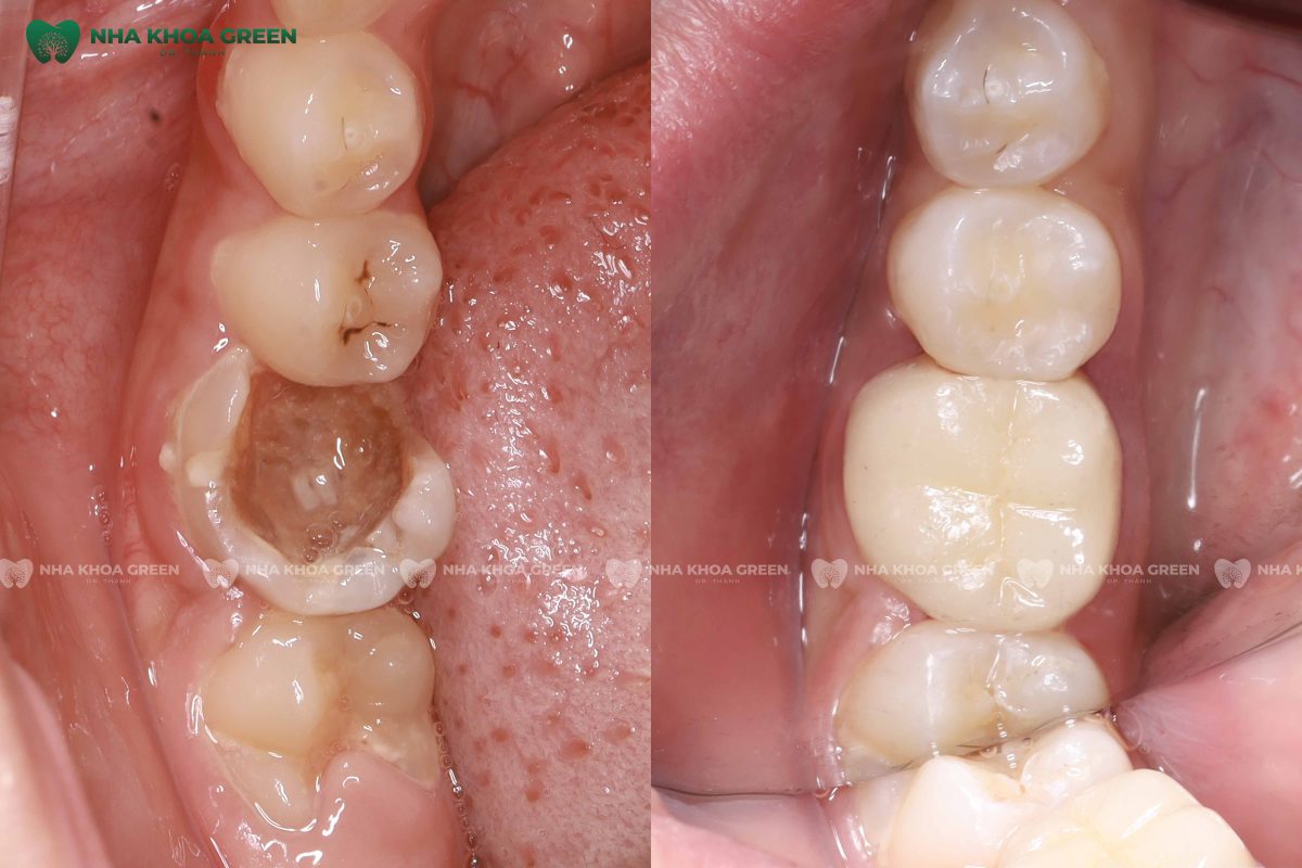 Răng đã lấy tủy tồn tại được bao lâu?